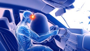 Accidentes de Auto y Conmoción Cerebral – Preguntas Frecuentes
