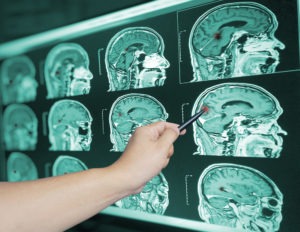 Carrollton Traumatic Brain Injury (TBI) Lawyer