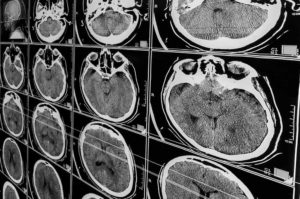 plano tx car accident lawyer traumatic brain injuries